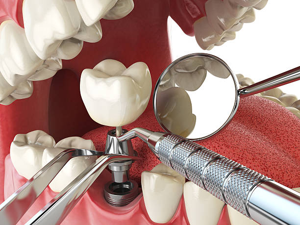 Best Emergency Tooth Extraction in Rochelle, IL